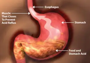 GERD - Stomach Image Showing how GERD Occurs