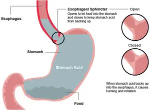 explanation of what causes heartburn